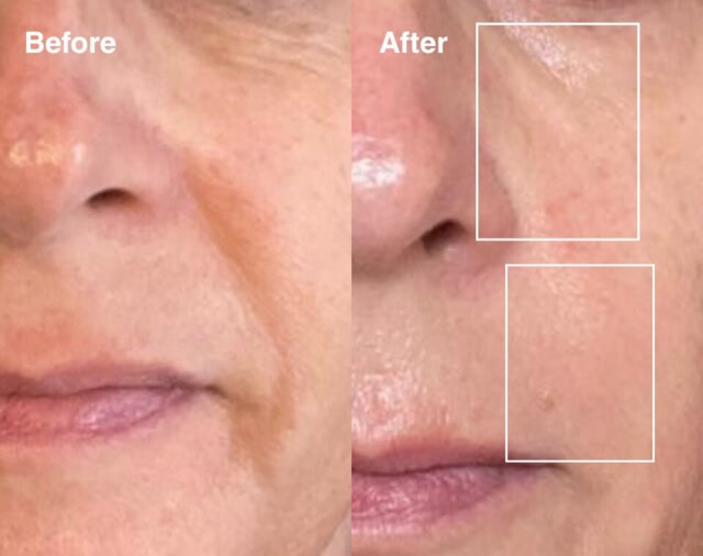Skin Rejuvenating LED face & neck mask
