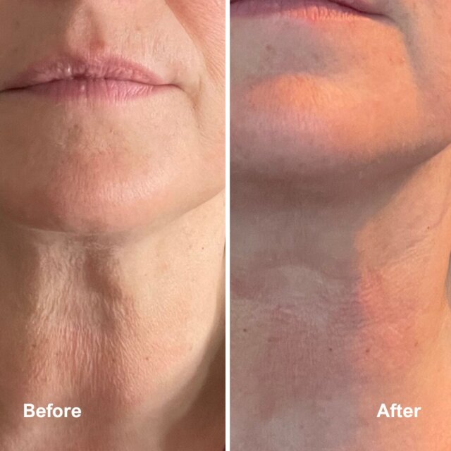 Skin Rejuvenating LED face & neck mask